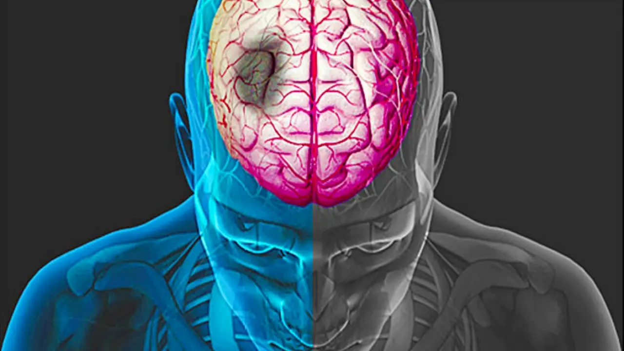 Mrtvice a Cévní mozkové příhody